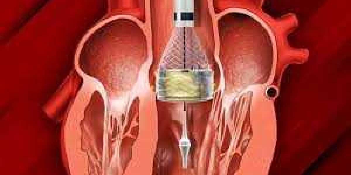 Understanding TAVI Surgery Cost in Chennai: Affordable Excellence in Heart Care