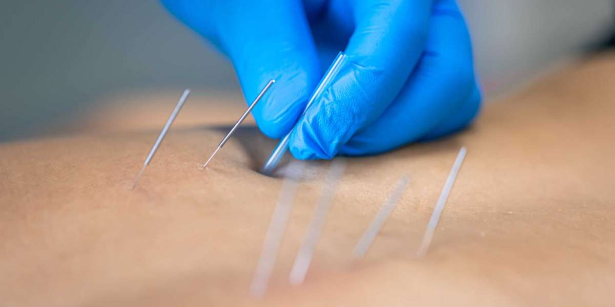 Transform Your Recovery with Dry Needling in Surrey: A Comprehensive Guide by Legend Physiotherapy