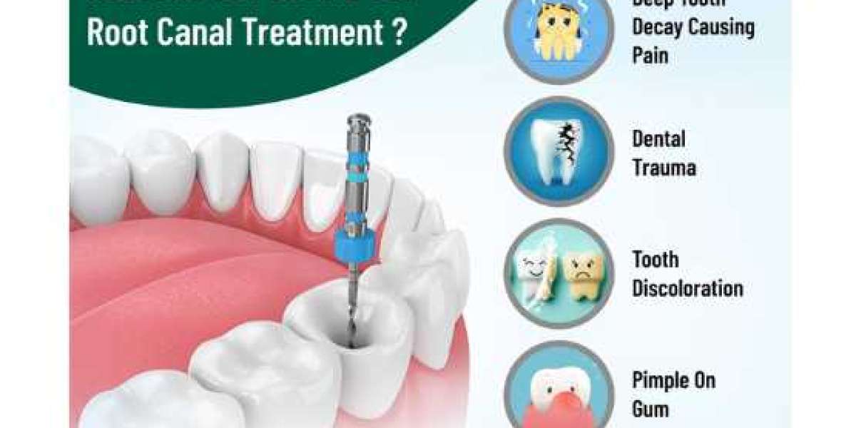 Painless Root Canal Treatment in Bangalore: A Comprehensive Guide