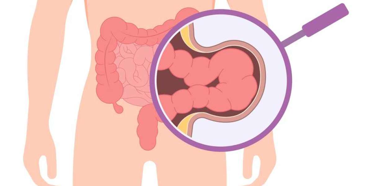 Hernia Symptoms: How to Recognize and Respond