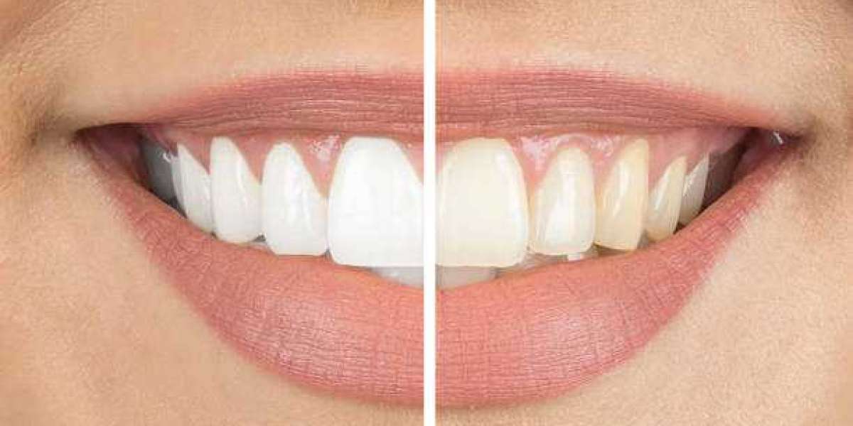 Achieve a Brilliant Smile with Expert Teeth Whitening in Riyadh