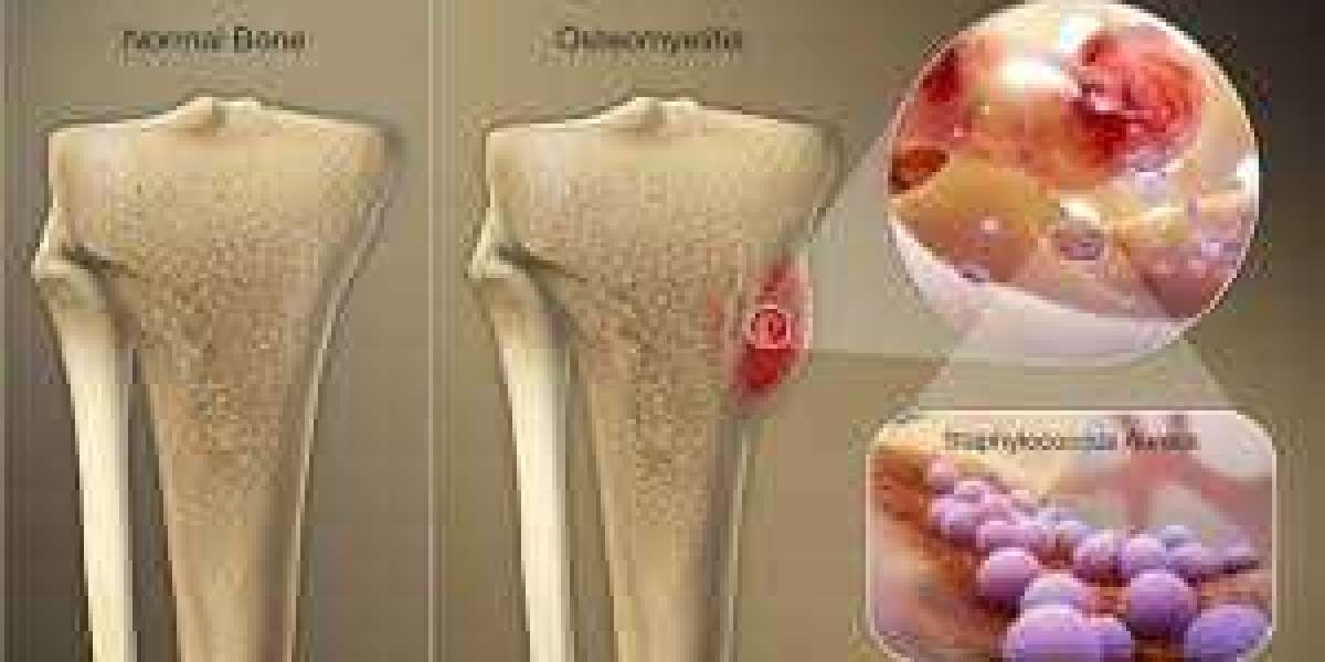 Insights into the Condition and Finding the Best Osteomyelitis Doctor for Your Treatment