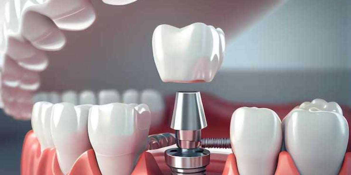 Is a Dental Implant the Right Choice for You? Find Out Now!