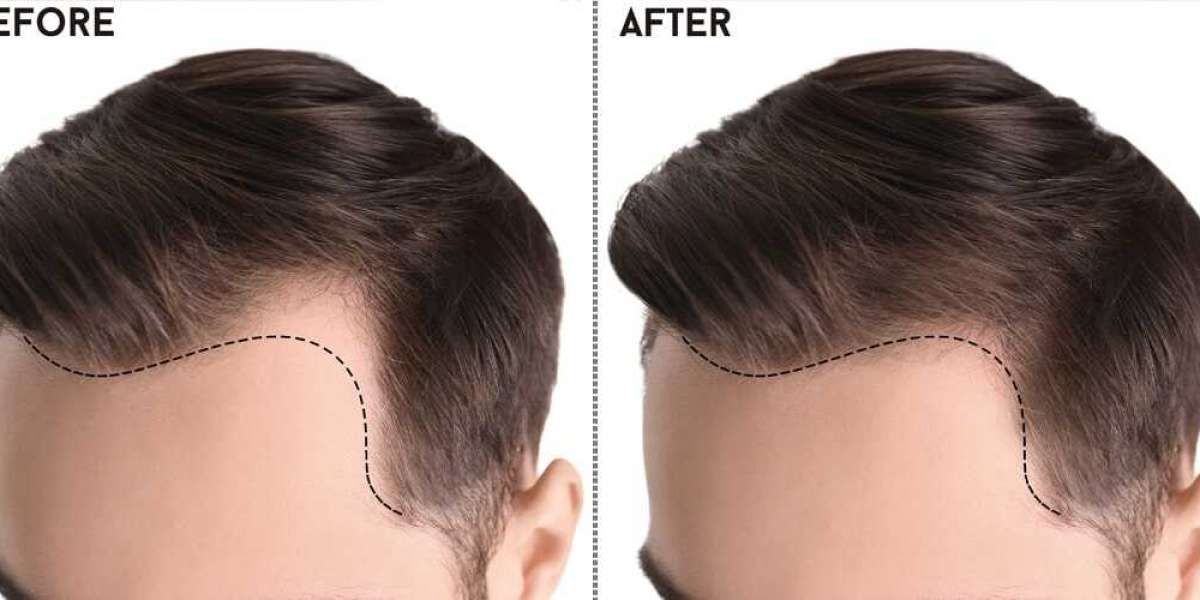 The Best Hair Transplant in Islamabad: Your Guide to Top Clinics and Techniques