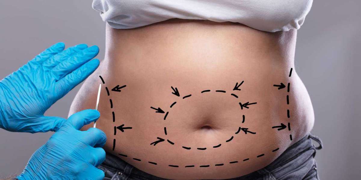 Innovations in Tummy Tuck Surgery: Insights from the Best Doctors in Dubai