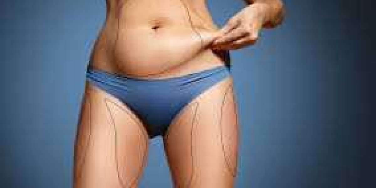 Laser SmartLipo: The Revolutionary Technique for Precise Fat Reduction and Body Sculpting