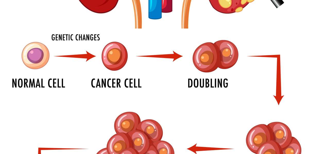 Kidney Cancer Treatment: Know how kidney cancer is treated