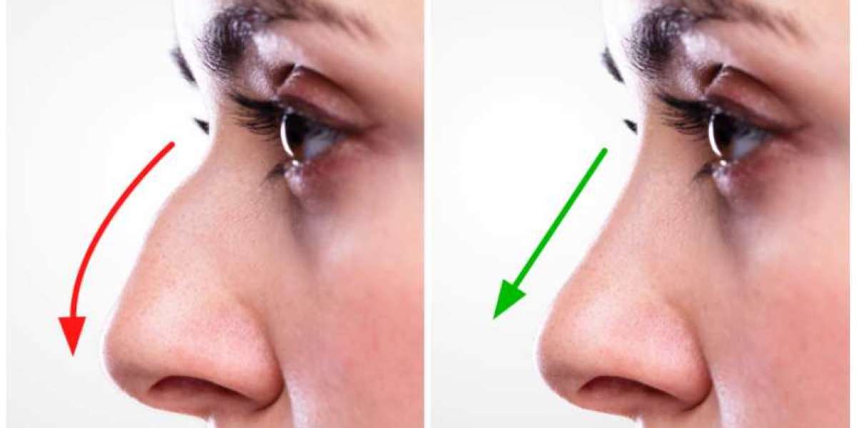 Finding the Best Rhinoplasty Surgeon in Lahore: A Comprehensive Guide