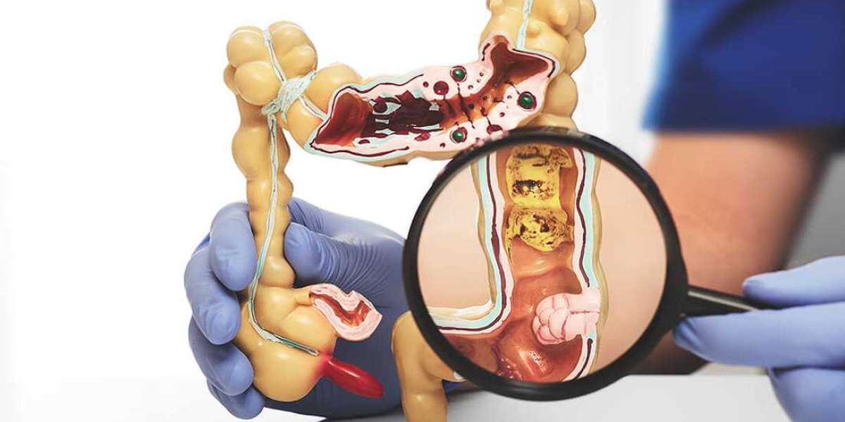 Why Should Colorectal Specialist Mumbai Your Health Issues