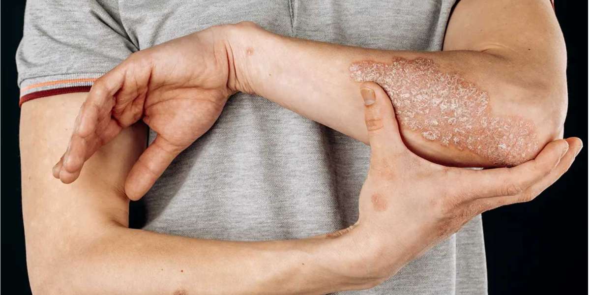 Psoriasis Diet Tips: Foods To Eat And Avoid