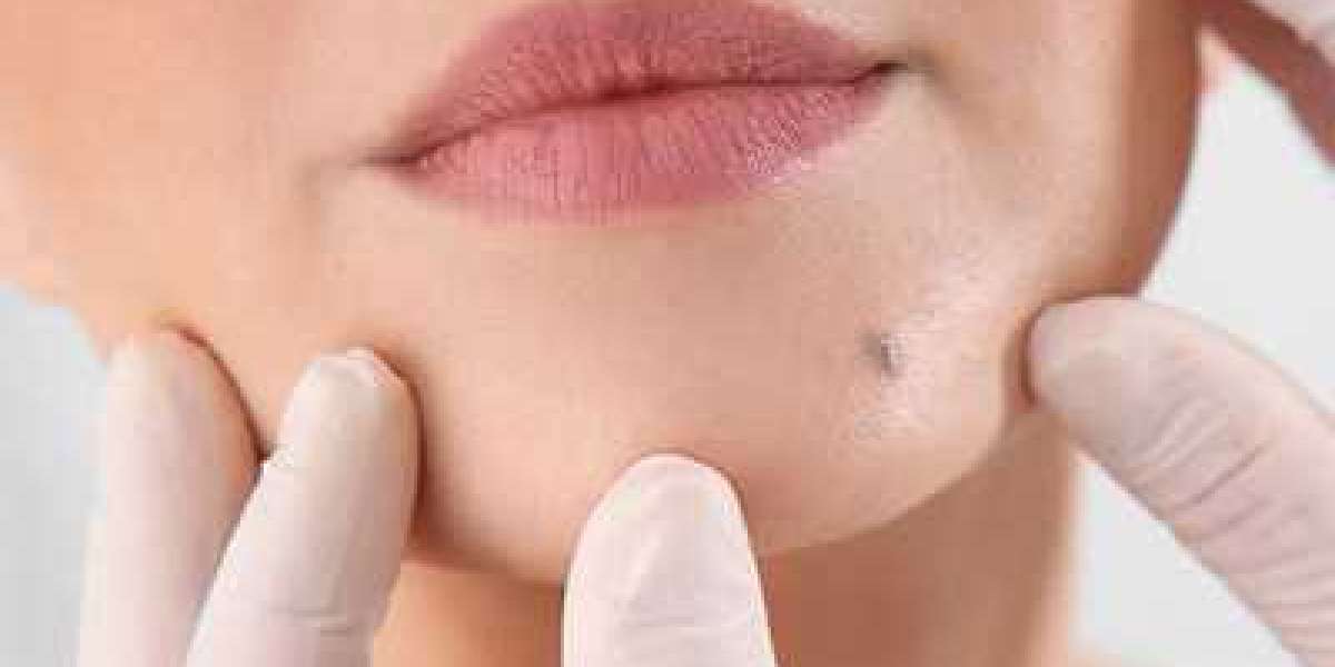 Understanding Hidden Fees in Mole Removal Procedures in Dubai