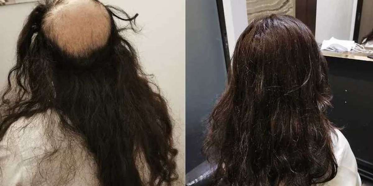 Singapore hair replacement system