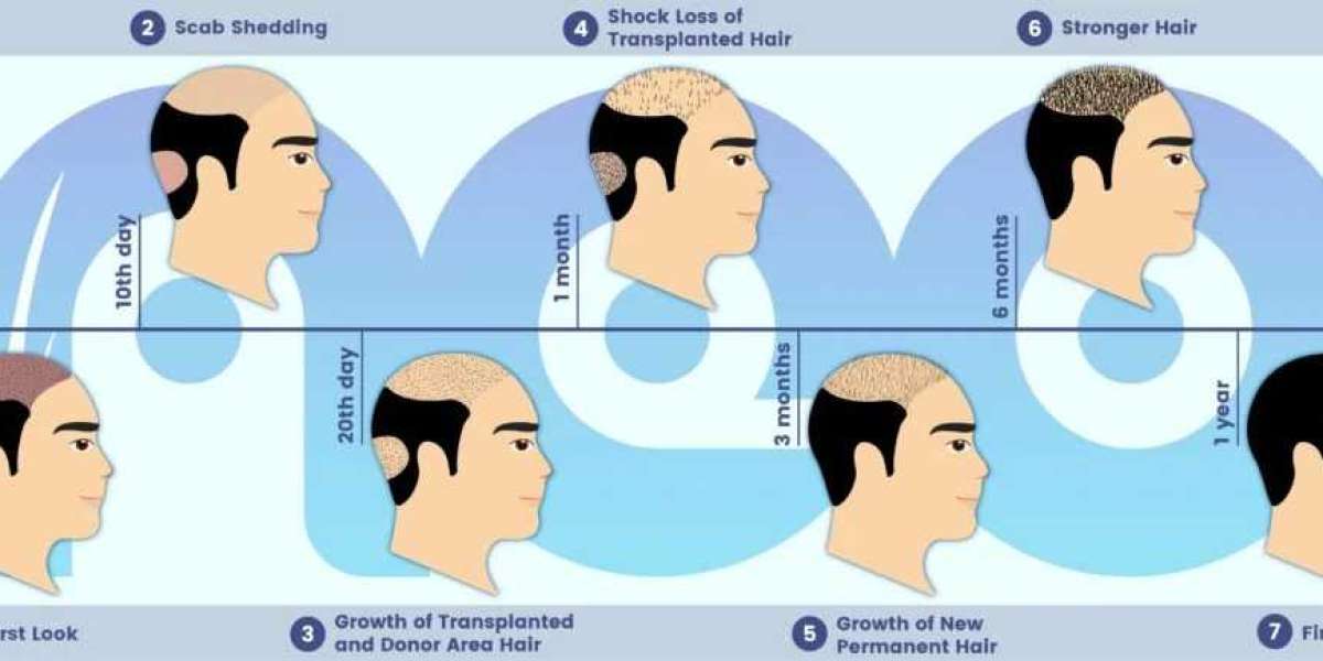 Why Hair Replacement Surgery in Turkey is the Ultimate Solution for Hair Loss