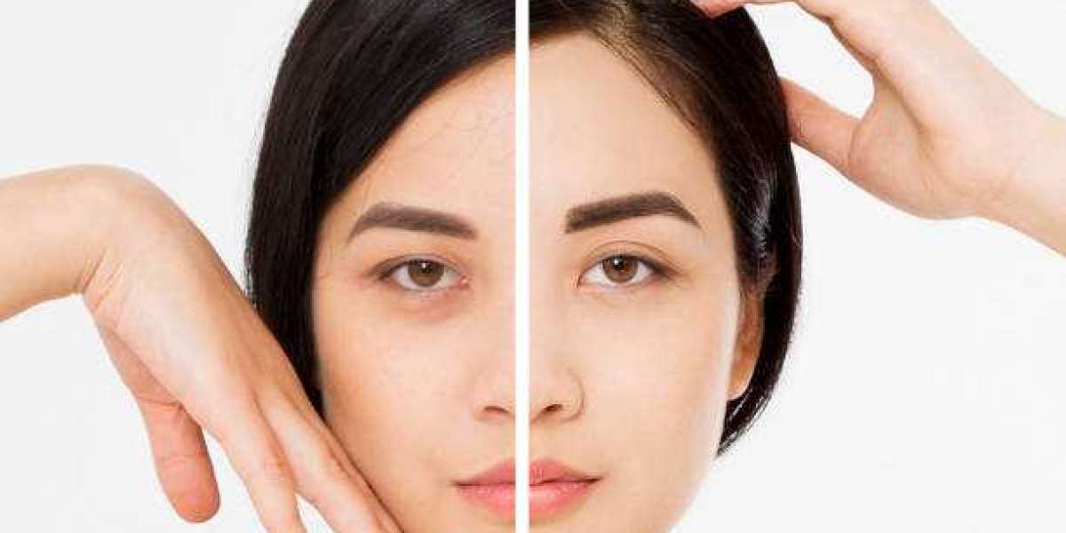 Bright Eyes Ahead: Comprehensive Guide to Dark Circle Treatments in Islamabad