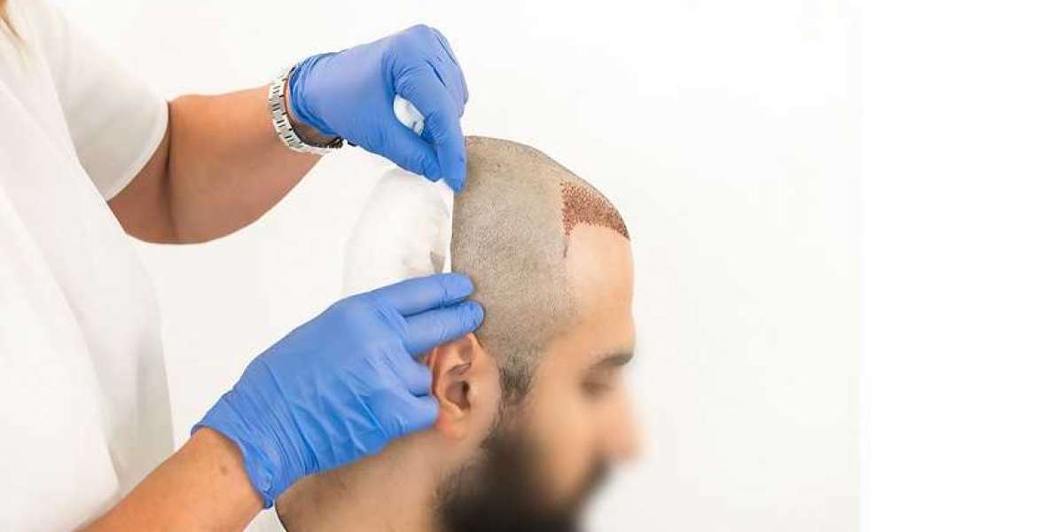 What is the Best Age for a Hair Transplant?