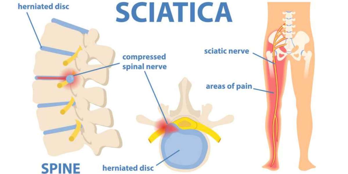 Sciatica Pain Relief: A Comprehensive Guide to Treatment Options