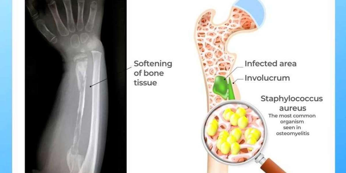 Osteomyelitis Treatment: Effective Approaches to Managing Bone Infection