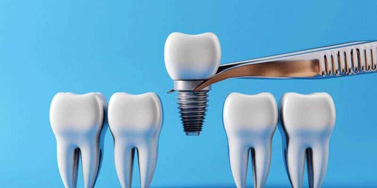 Regain Confidence with Durable Dental Implant Procedures