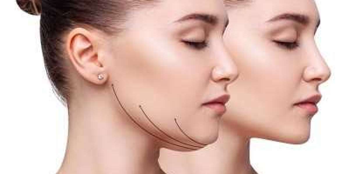 Fast Double Chin Removal in Islamabad: Quick Solutions for a Sculpted Jawline