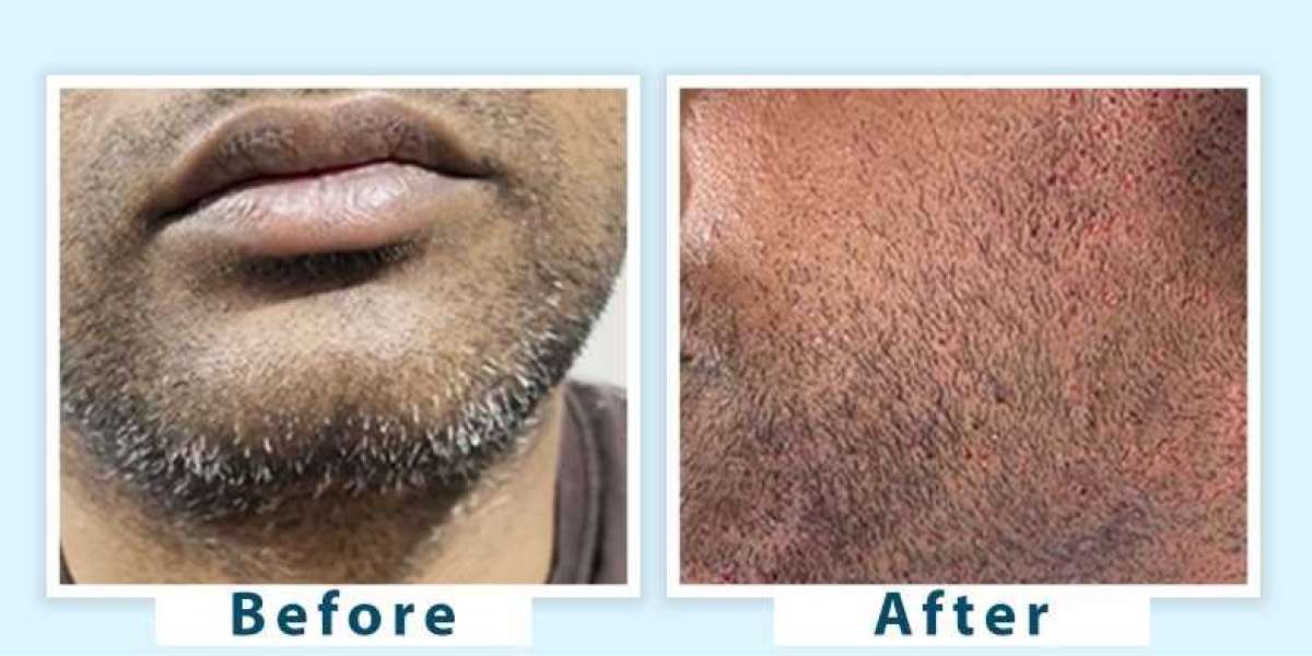 Premature Beard Greying Treatment in Delhi Natural and Advanced Remedies That Work