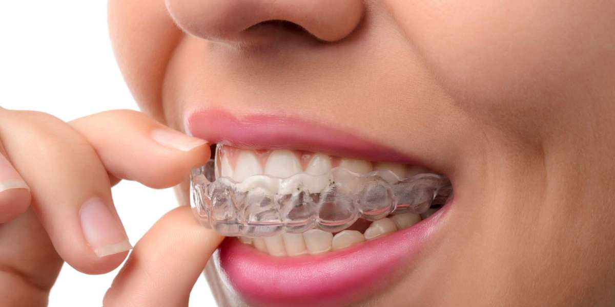 How Soon Do Teeth Move with Aligners?