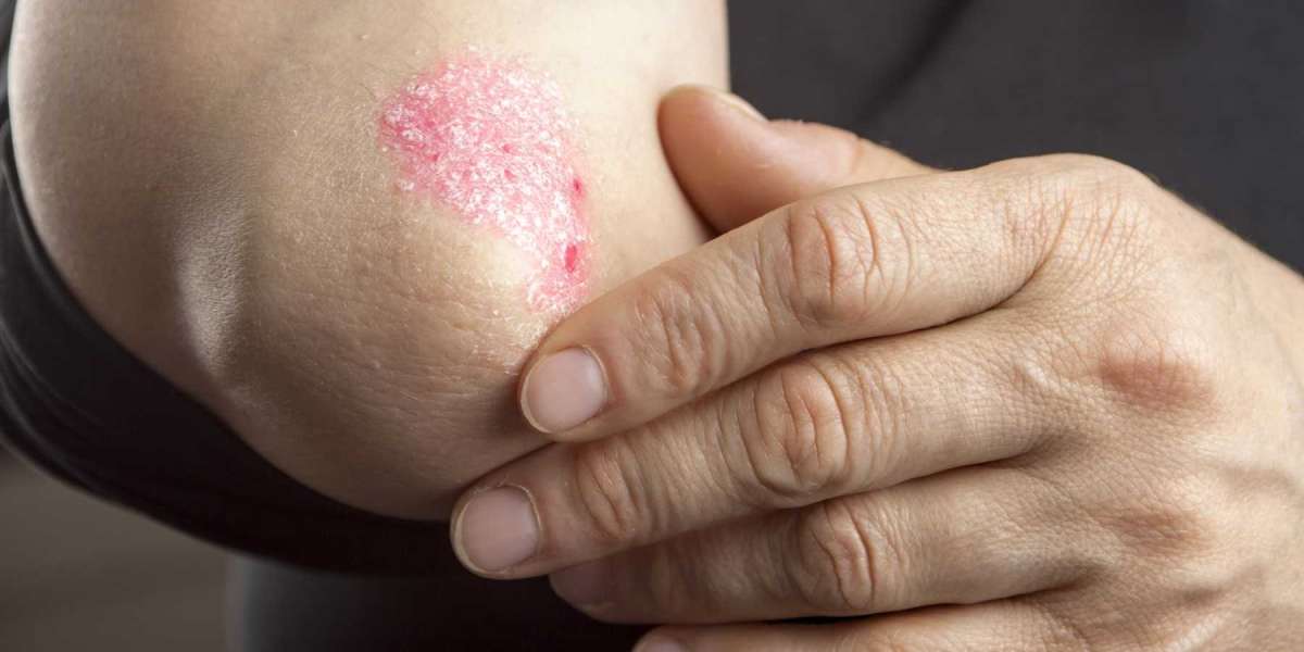 Psoriasis Treatment Drugs Market Size, Share and Forecast by 2025-2033