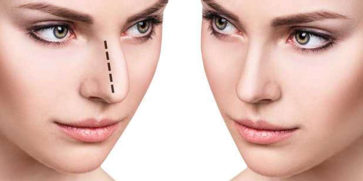 From Hump to Harmony: Rhinoplasty in Riyadh