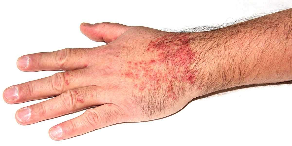 Eczema Relief Reimagined: How OPZELURA Is Reshaping Atopic Dermatitis Therapy