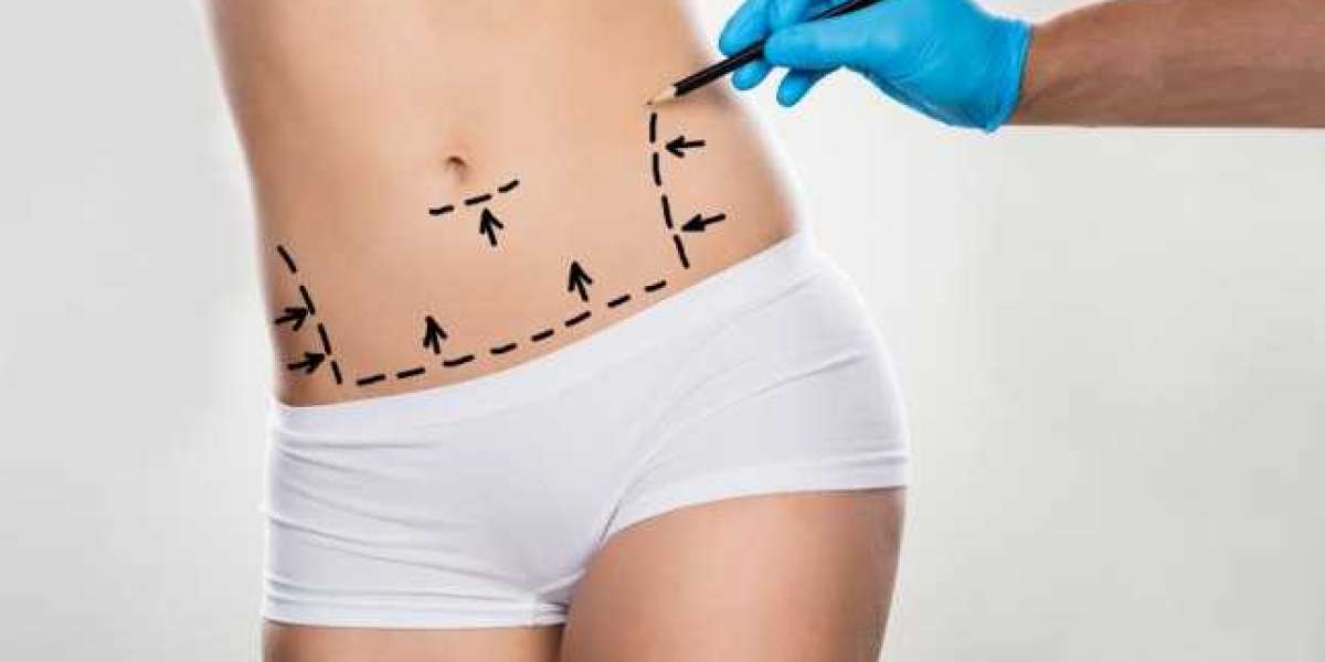 Revolutionary Liposuction in Riyadh for Lasting Results