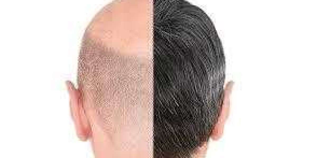 Hair Transplant in Dubai – Before & After Transformations