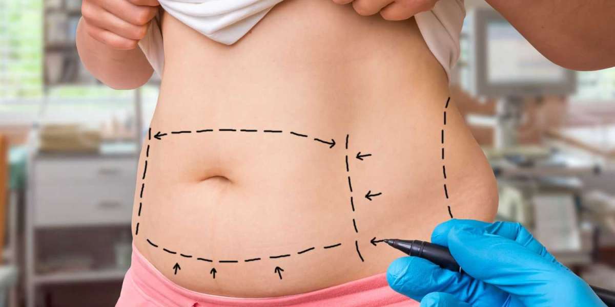 Liposuction Post-Operative Care in Riyadh