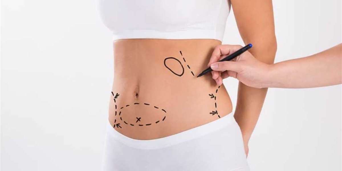 Modern Liposuction in Riyadh: Reshape Your Future