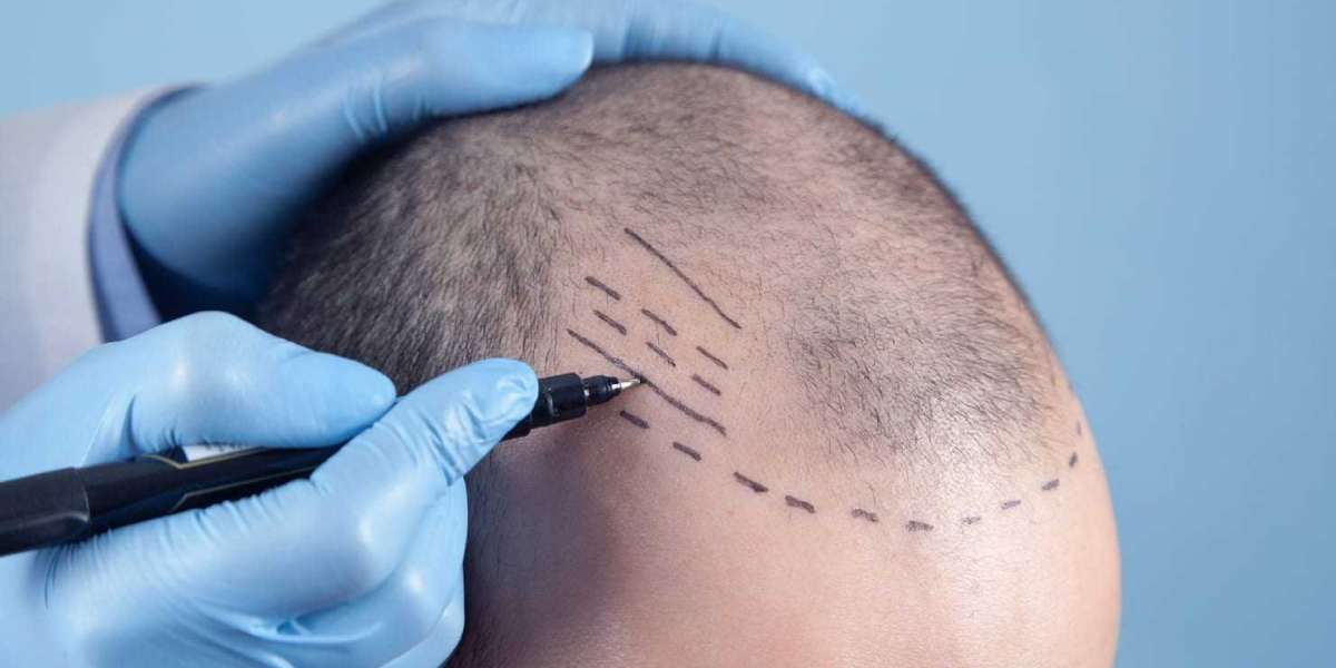 Everything You Should Know Before Your Hair Transplant in Riyadh