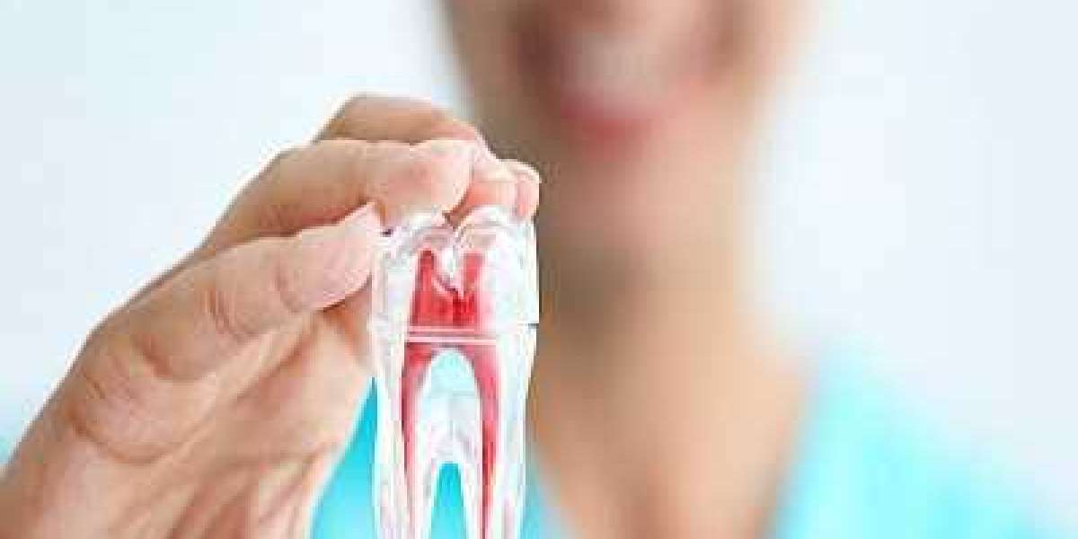 You Only Need a Root Canal Treatment in Islamabad if You Have Severe Pain – Myth or Reality?