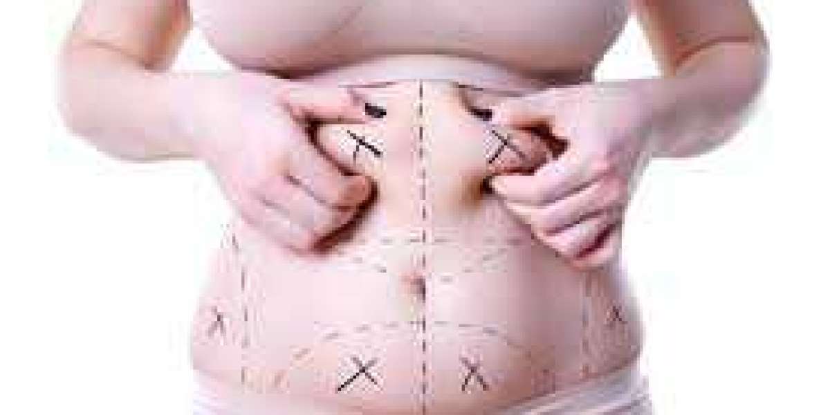 Transform Your Look with Liposuction in Islamabad