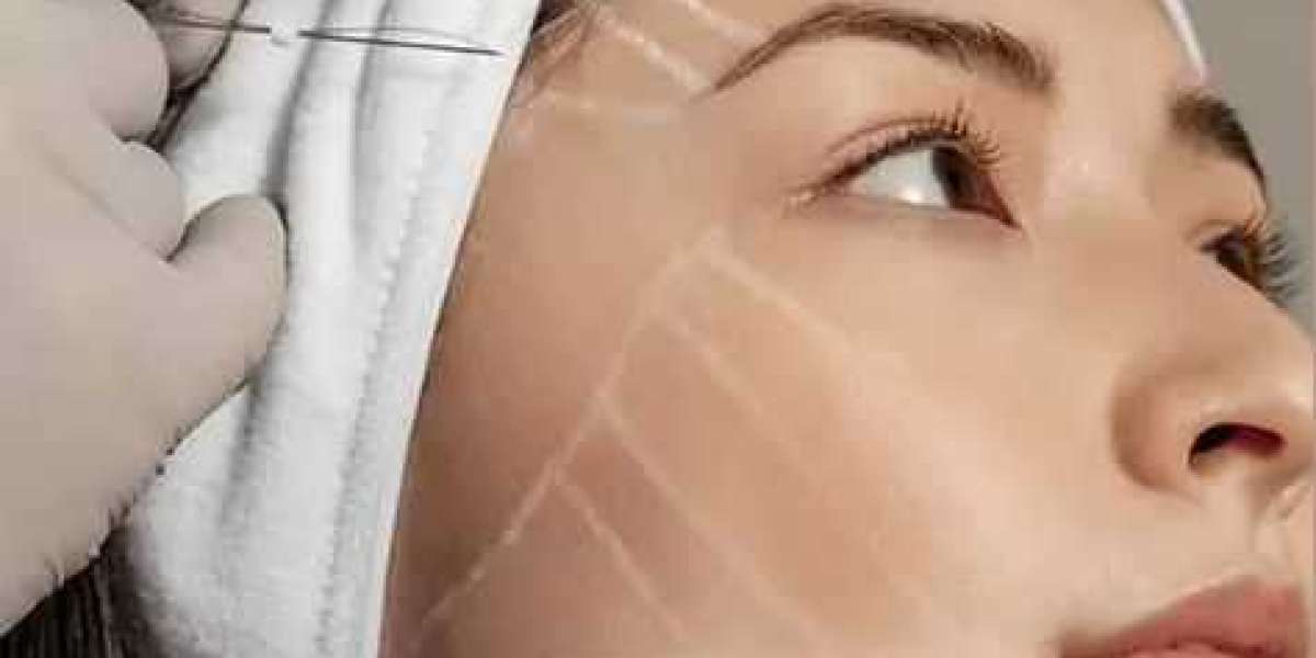 Enhance Your Facial Contours with Thread Lift Procedures in Islamabad