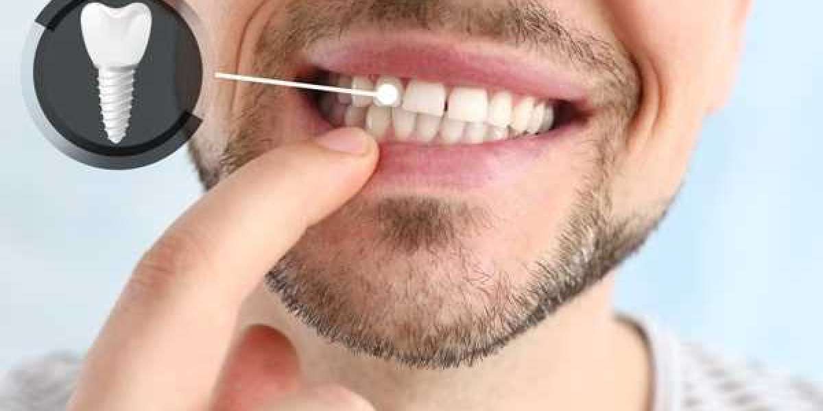 Are Dental Implants Safe? Understanding the Risks and Safety in Islamabad