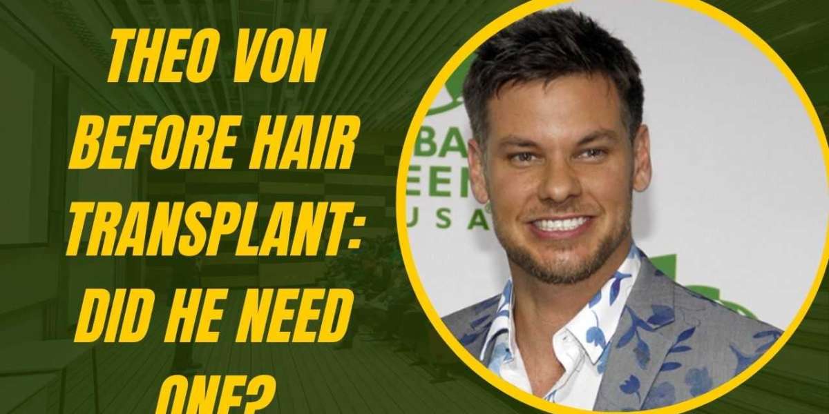 Theo Von Before Hair Transplant: Did He Need One?