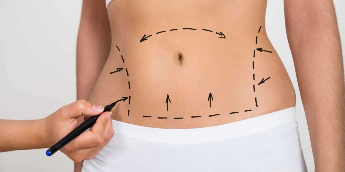 Liposuction in Riyadh: Everything You Need to Know