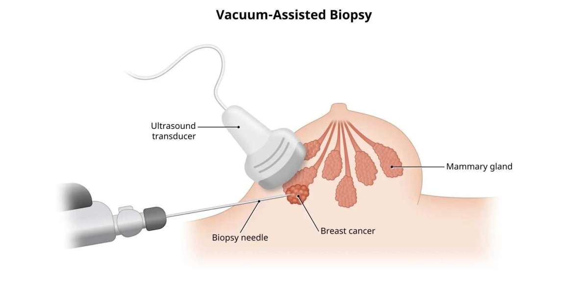 Can a Biopsy Be Wrong? Accuracy and Limitations