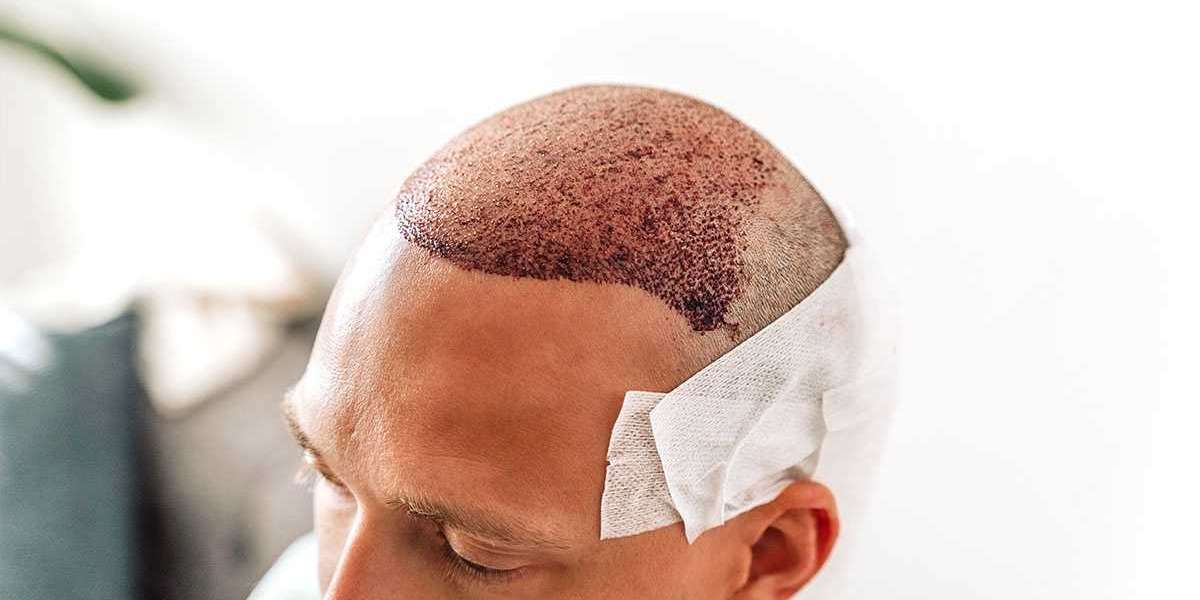 Hair Transplant in Riyadh: Everything You Need to Know